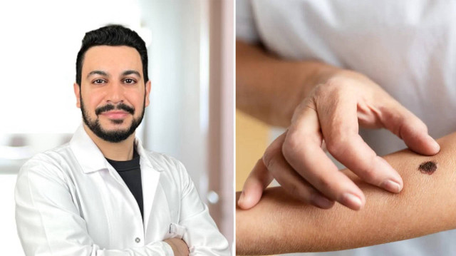 uzmanlar-uyariyor-turkiyede-cilt-kanserinde-tehlikeli-artis-Y9hcckk2.jpeg